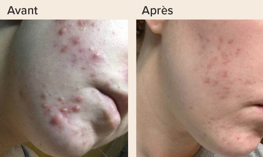 Acne-solution